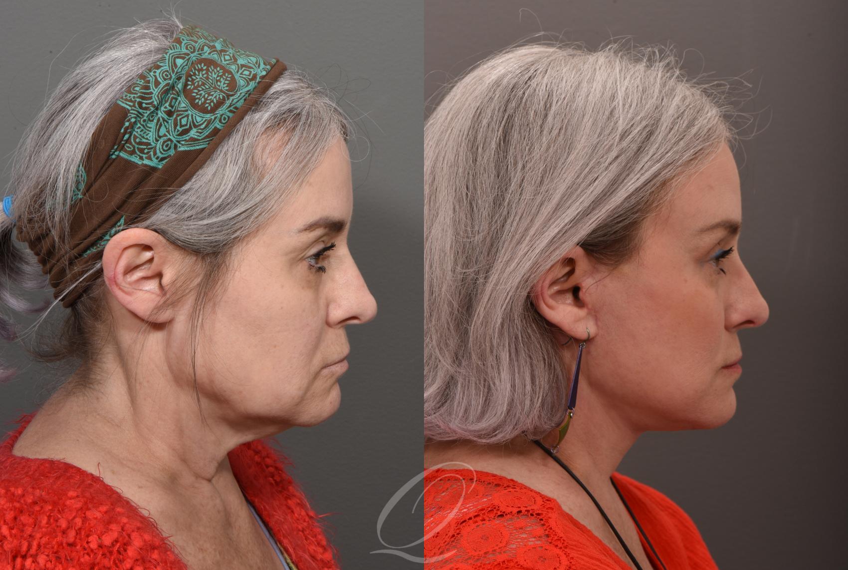 Facelift Case 1001504 Before & After Right Side | Serving Rochester, Syracuse & Buffalo, NY | Quatela Center for Plastic Surgery