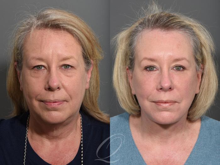 Facelift Case 1001507 Before & After Front | Serving Rochester, Syracuse & Buffalo, NY | Quatela Center for Plastic Surgery