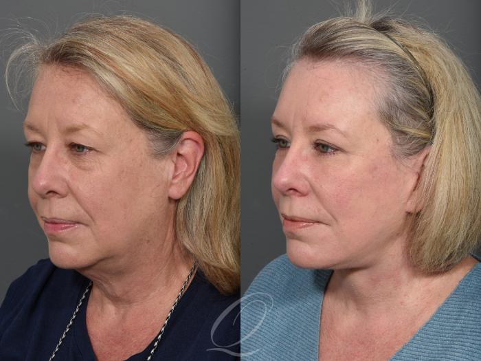 Facelift Case 1001507 Before & After Left Oblique | Serving Rochester, Syracuse & Buffalo, NY | Quatela Center for Plastic Surgery