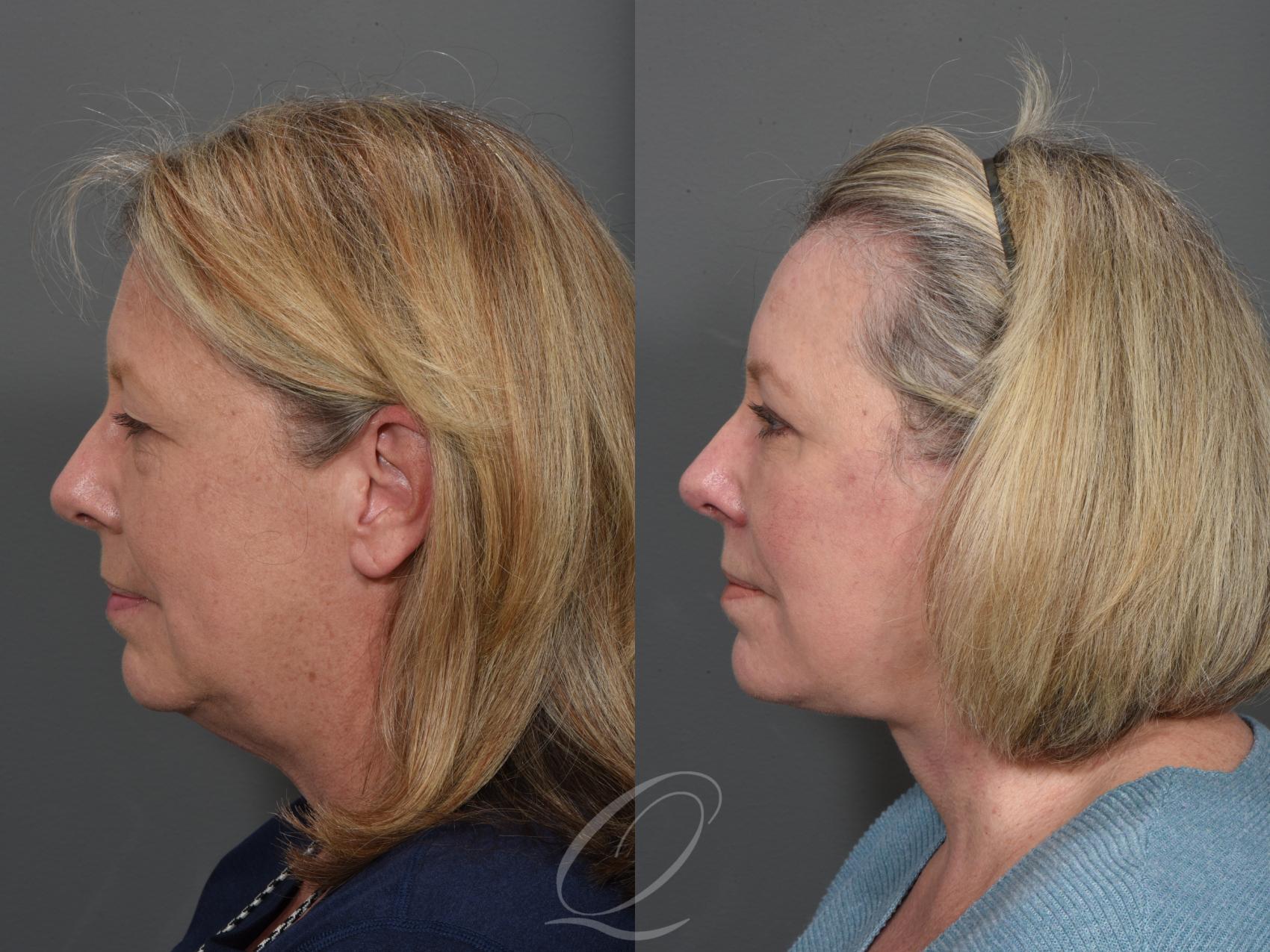 Eyelid Lift Case 1001507 Before & After Left Side | Serving Rochester, Syracuse & Buffalo, NY | Quatela Center for Plastic Surgery