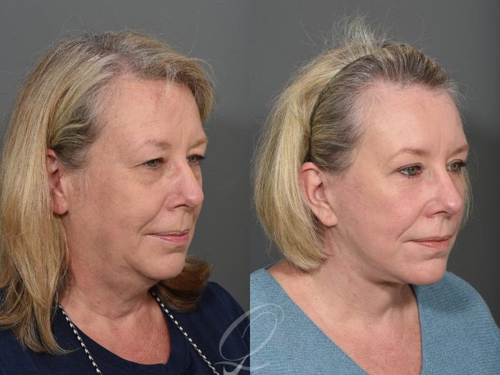 Eyelid Lift Case 1001507 Before & After Right Oblique | Serving Rochester, Syracuse & Buffalo, NY | Quatela Center for Plastic Surgery