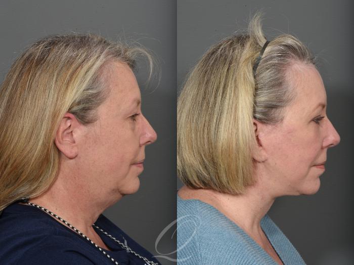 Brow Lift Case 1001507 Before & After Right Side | Serving Rochester, Syracuse & Buffalo, NY | Quatela Center for Plastic Surgery