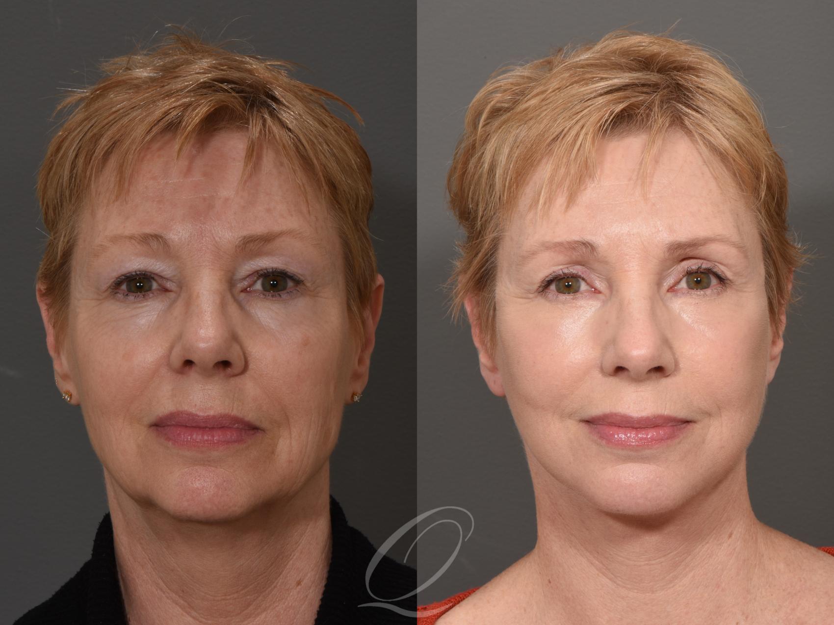 Skin Resurfacing Case 1001508 Before & After Front | Serving Rochester, Syracuse & Buffalo, NY | Quatela Center for Plastic Surgery