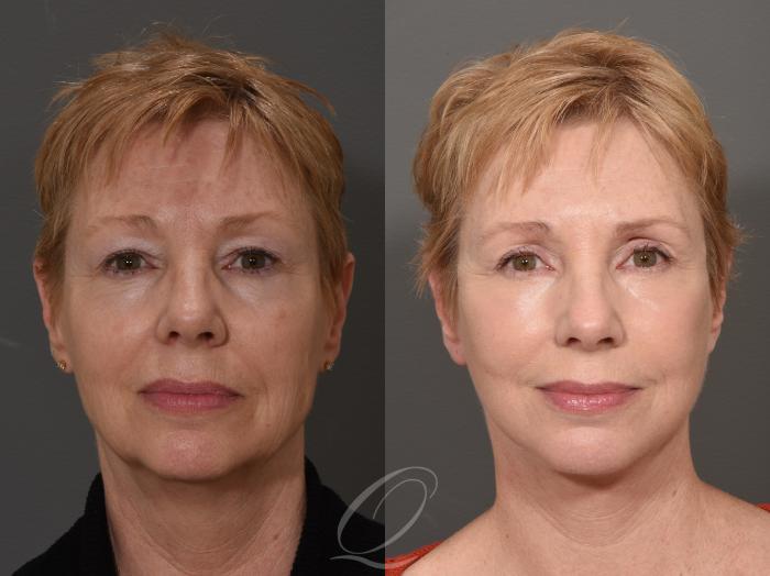 Facelift Case 1001508 Before & After Front | Serving Rochester, Syracuse & Buffalo, NY | Quatela Center for Plastic Surgery