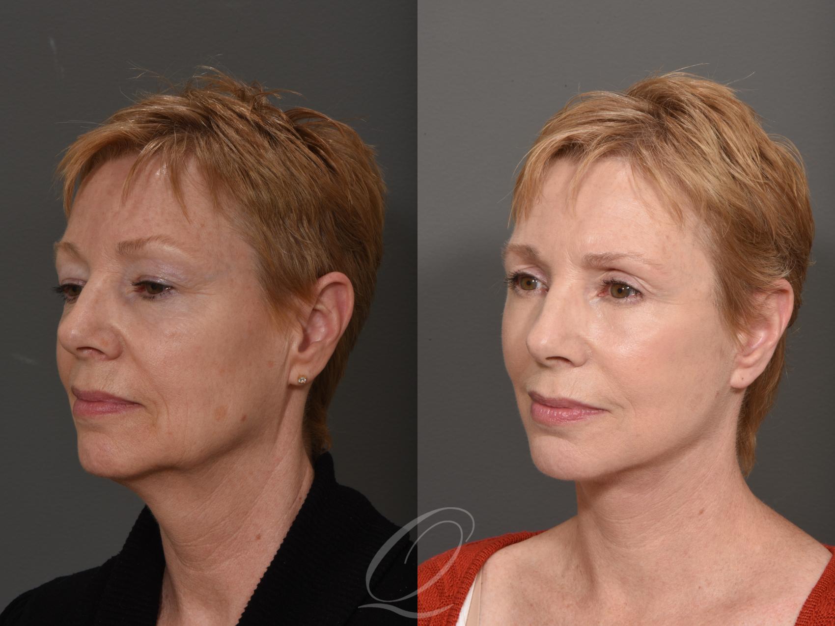 Eyelid Lift Case 1001508 Before & After Left Oblique | Serving Rochester, Syracuse & Buffalo, NY | Quatela Center for Plastic Surgery