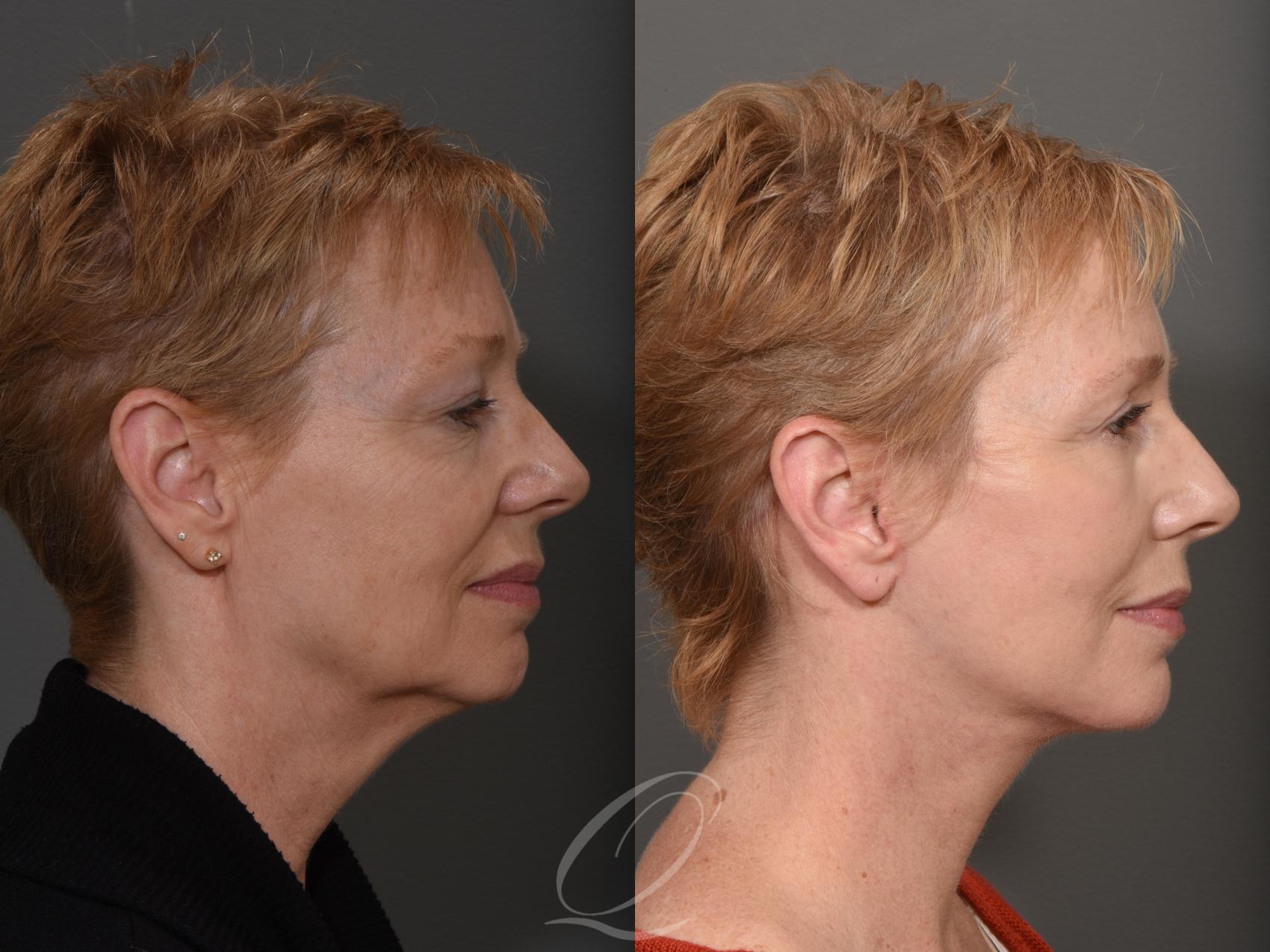 Skin Resurfacing Case 1001508 Before & After Right Side | Serving Rochester, Syracuse & Buffalo, NY | Quatela Center for Plastic Surgery