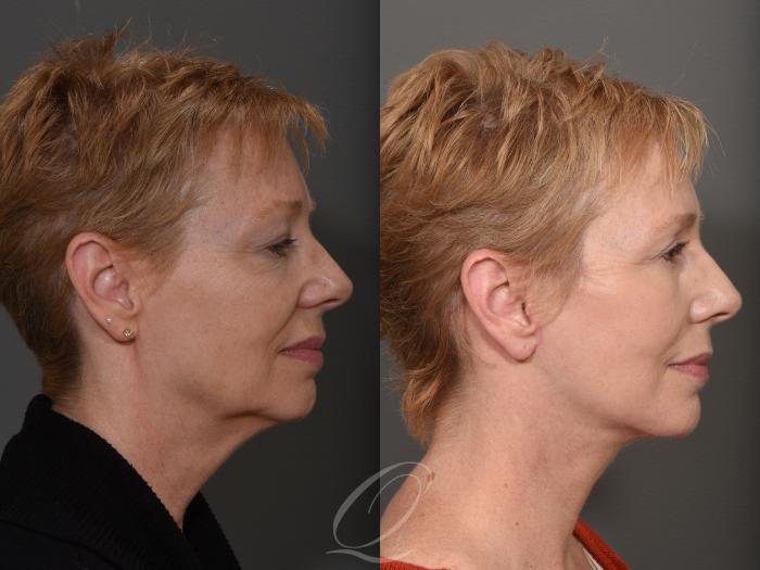 Facelift Case 1001508 Before & After Right Side | Serving Rochester, Syracuse & Buffalo, NY | Quatela Center for Plastic Surgery