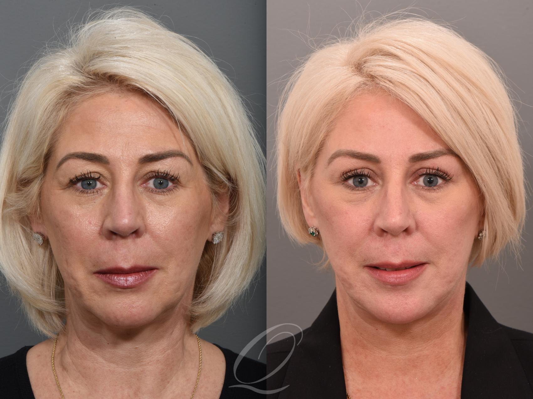 Facelift Case 1001509 Before & After Front | Serving Rochester, Syracuse & Buffalo, NY | Quatela Center for Plastic Surgery