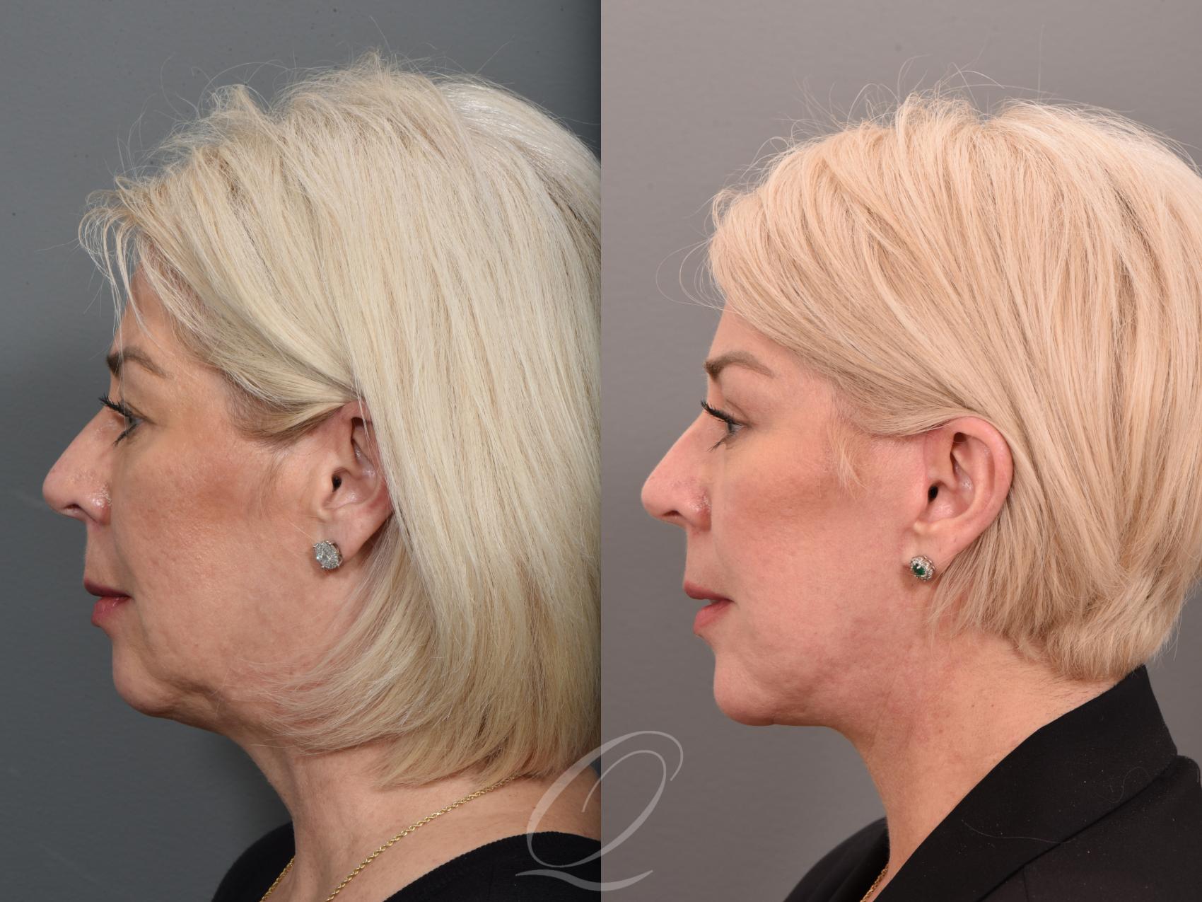 Facelift Case 1001509 Before & After Left Side | Serving Rochester, Syracuse & Buffalo, NY | Quatela Center for Plastic Surgery