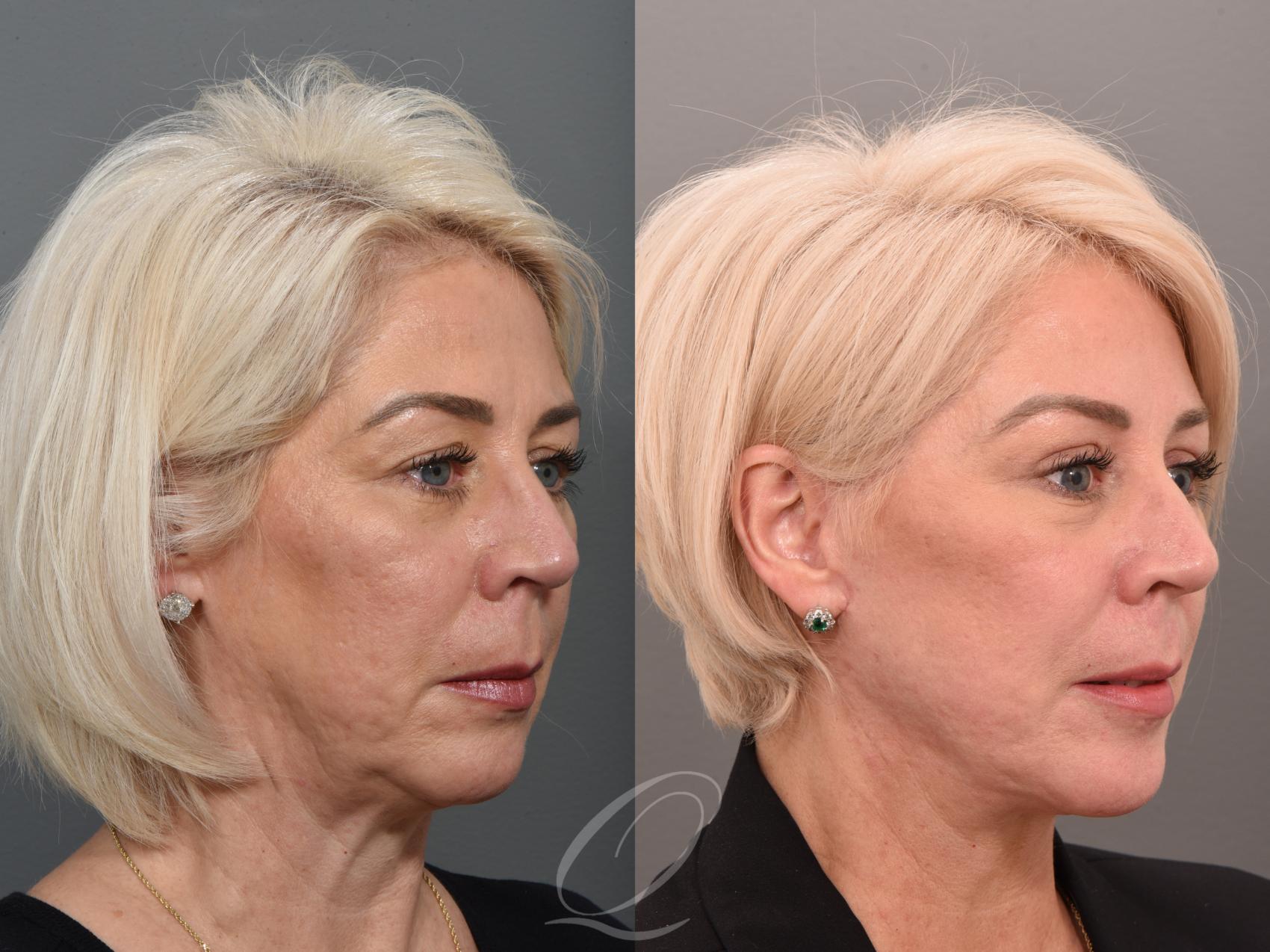 Facelift Case 1001509 Before & After Right Oblique | Serving Rochester, Syracuse & Buffalo, NY | Quatela Center for Plastic Surgery
