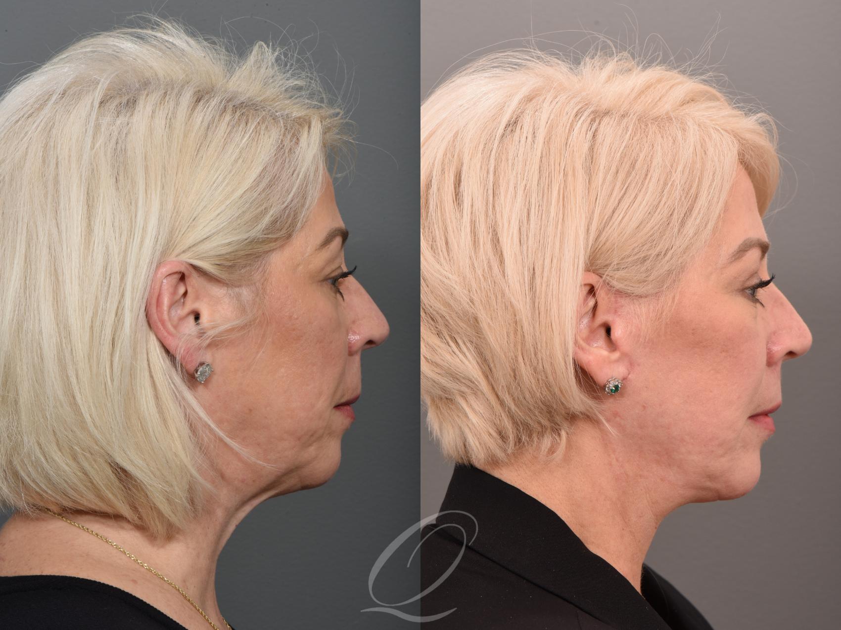 Facelift Case 1001509 Before & After Right Side | Serving Rochester, Syracuse & Buffalo, NY | Quatela Center for Plastic Surgery