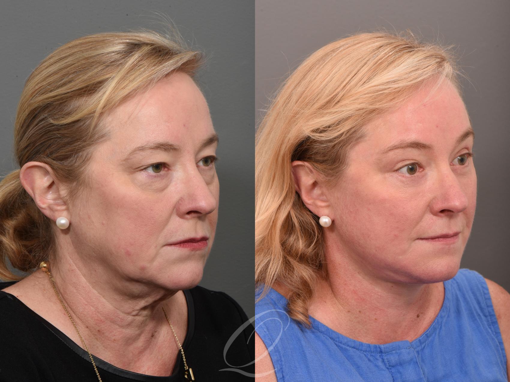 Eyelid Lift Case 1001511 Before & After Right Oblique | Serving Rochester, Syracuse & Buffalo, NY | Quatela Center for Plastic Surgery
