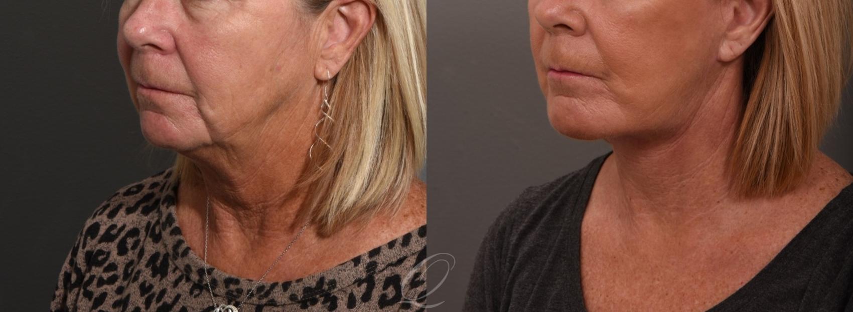 Facelift Case 1001512 Before & After Left Oblique | Serving Rochester, Syracuse & Buffalo, NY | Quatela Center for Plastic Surgery