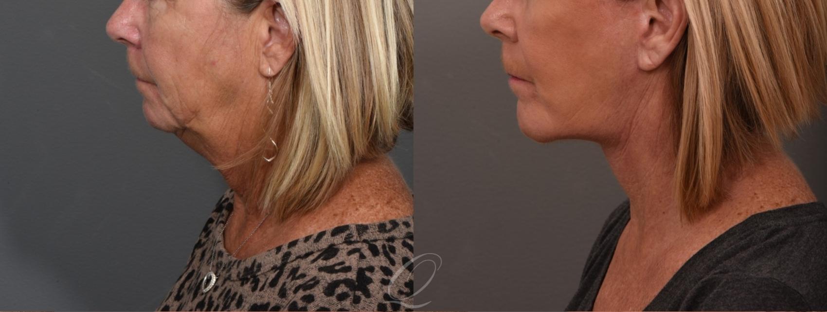 Chin Augmentation Case 1001512 Before & After Left Side | Serving Rochester, Syracuse & Buffalo, NY | Quatela Center for Plastic Surgery