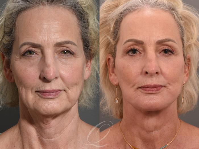 Facelift Case 1001540 Before & After Front | Serving Rochester, Syracuse & Buffalo, NY | Quatela Center for Plastic Surgery