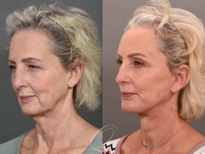 Facelift Case 1001540 Before & After Left Oblique | Serving Rochester, Syracuse & Buffalo, NY | Quatela Center for Plastic Surgery