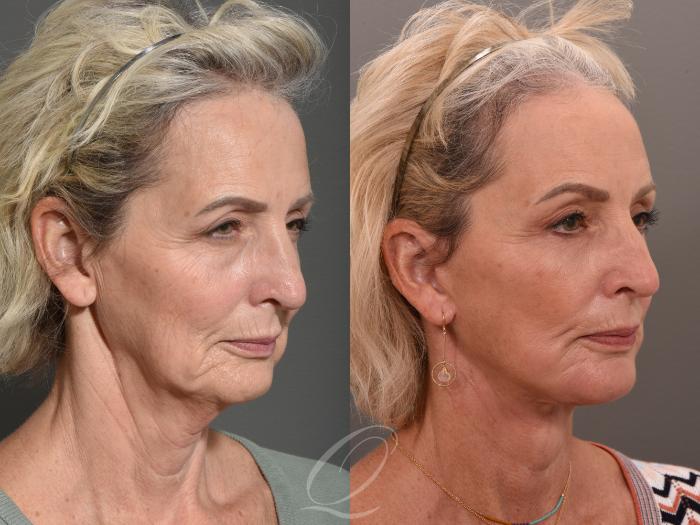 Facelift Case 1001540 Before & After Right Oblique | Serving Rochester, Syracuse & Buffalo, NY | Quatela Center for Plastic Surgery