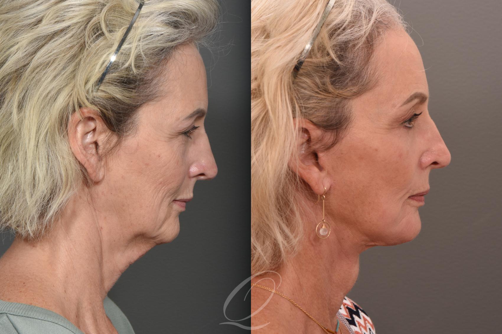 Facelift Case 1001540 Before & After Right Side | Serving Rochester, Syracuse & Buffalo, NY | Quatela Center for Plastic Surgery