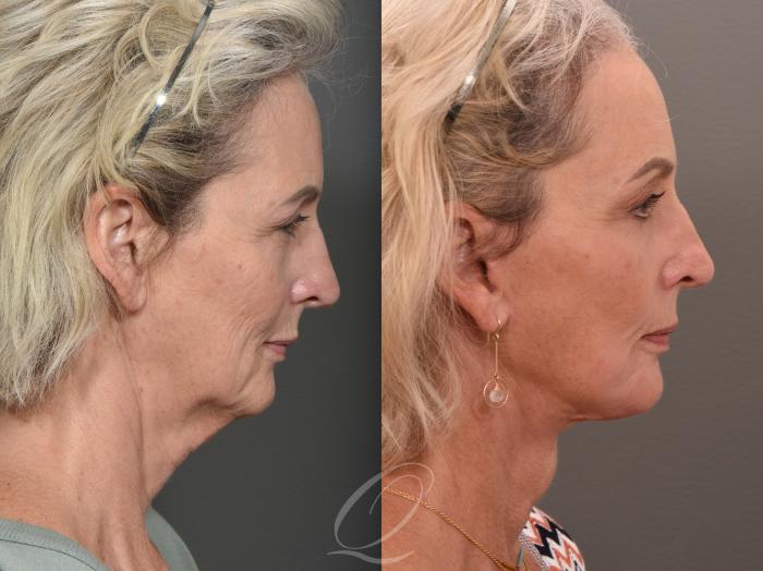 Facelift Case 1001540 Before & After Right Side | Serving Rochester, Syracuse & Buffalo, NY | Quatela Center for Plastic Surgery