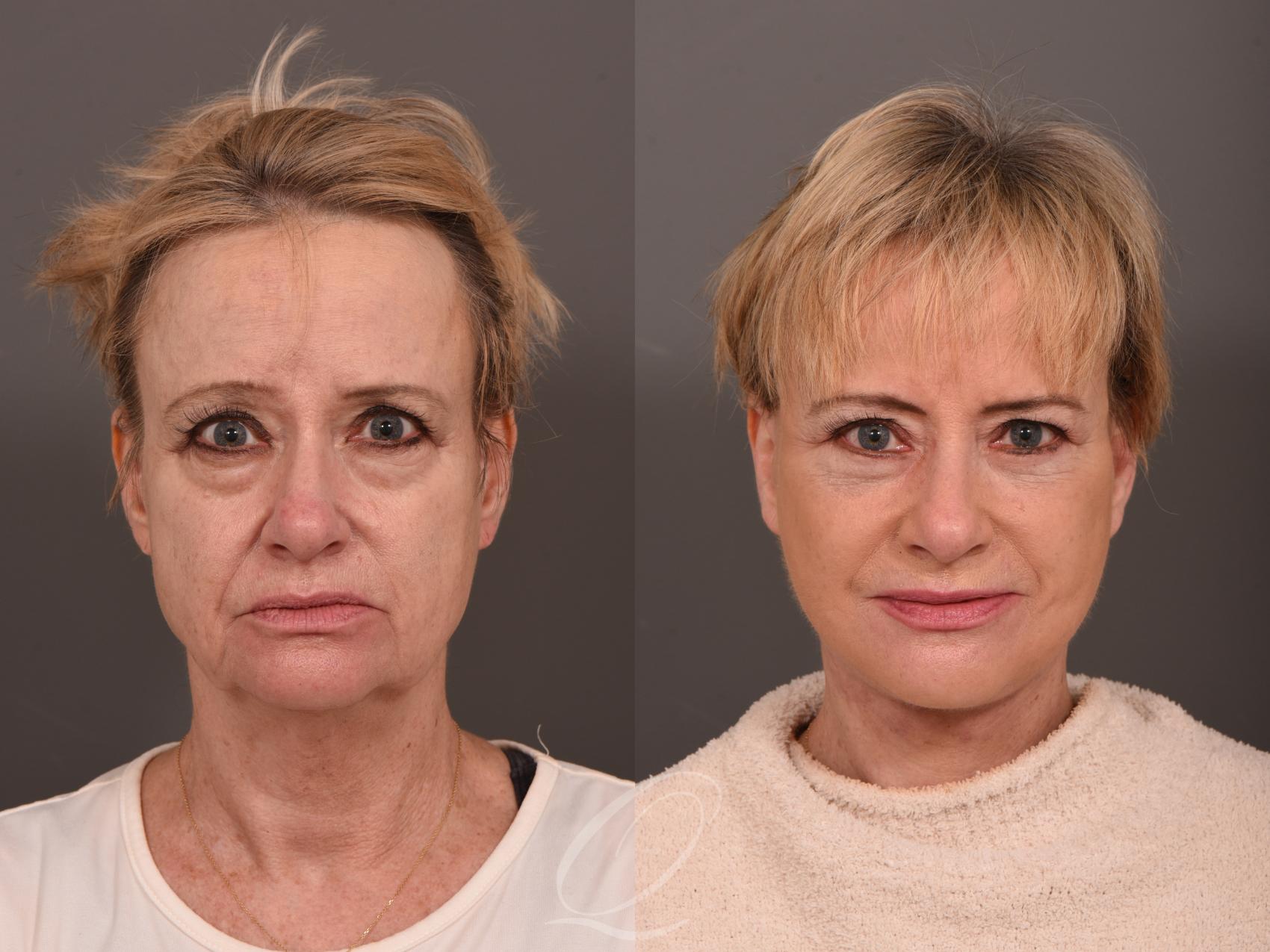 Facelift Case 1001541 Before & After Front | Serving Rochester, Syracuse & Buffalo, NY | Quatela Center for Plastic Surgery