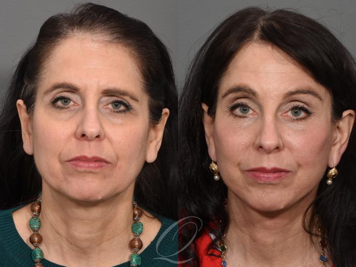 Facelift Case 1001546 Before & After Front | Serving Rochester, Syracuse & Buffalo, NY | Quatela Center for Plastic Surgery