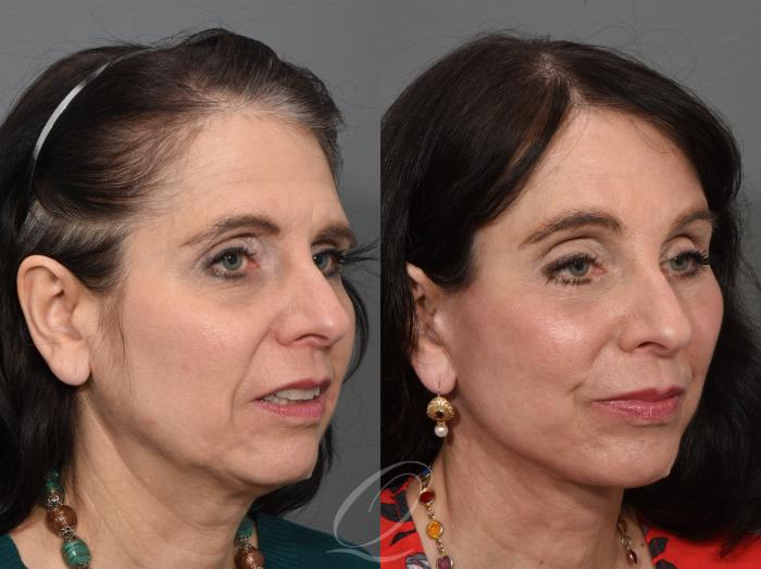 Eyelid Lift Case 1001546 Before & After Right Oblique | Serving Rochester, Syracuse & Buffalo, NY | Quatela Center for Plastic Surgery