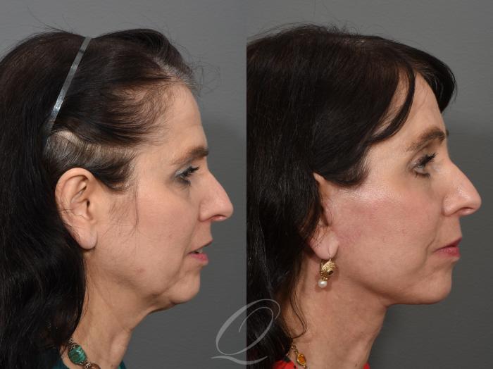 Eyelid Lift Case 1001546 Before & After Right Side | Serving Rochester, Syracuse & Buffalo, NY | Quatela Center for Plastic Surgery