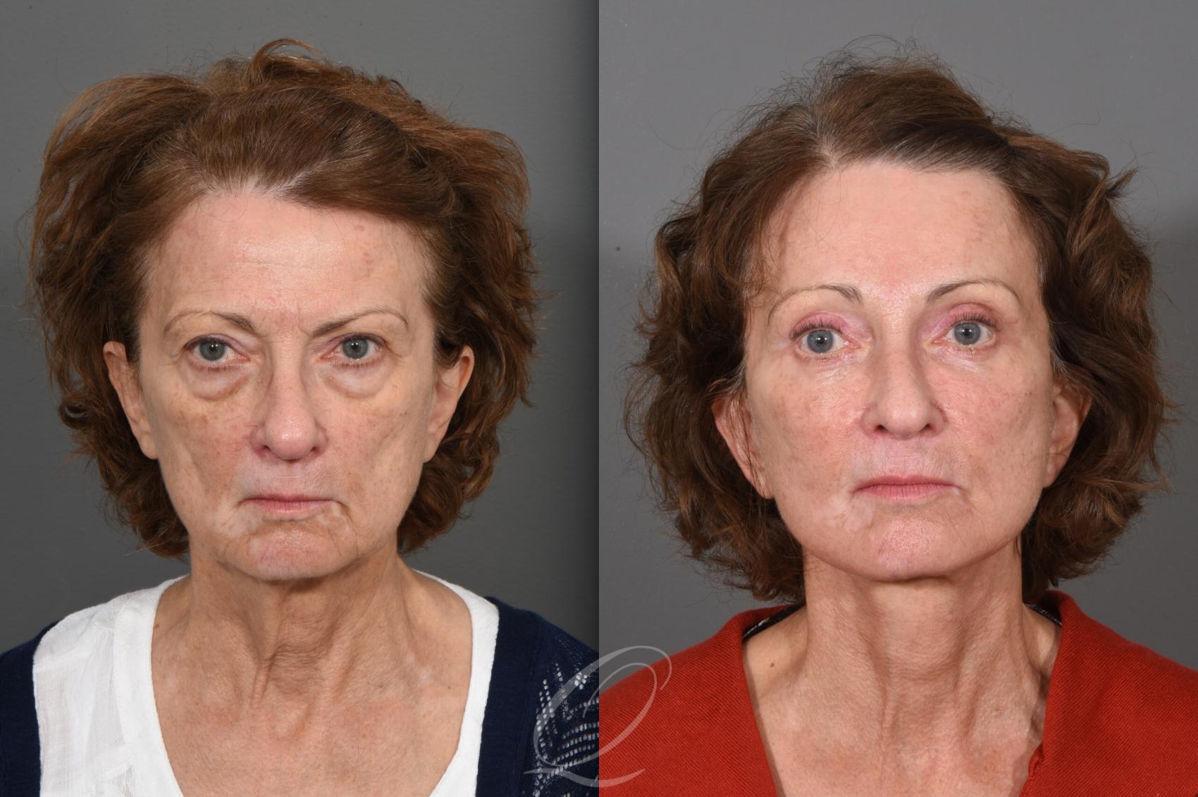 Brow Lift Case 1001547 Before & After Front | Serving Rochester, Syracuse & Buffalo, NY | Quatela Center for Plastic Surgery