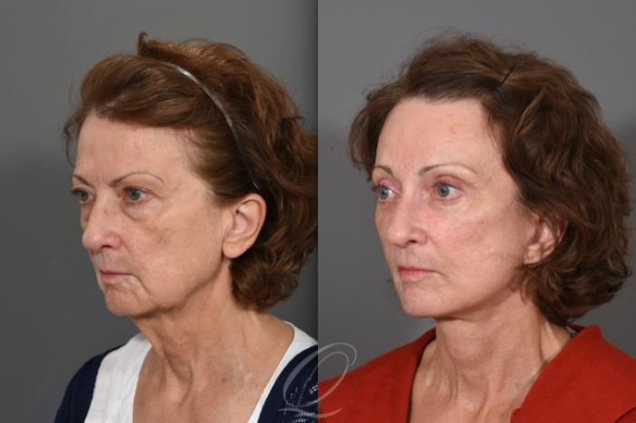 Facelift Case 1001547 Before & After Left Oblique | Serving Rochester, Syracuse & Buffalo, NY | Quatela Center for Plastic Surgery