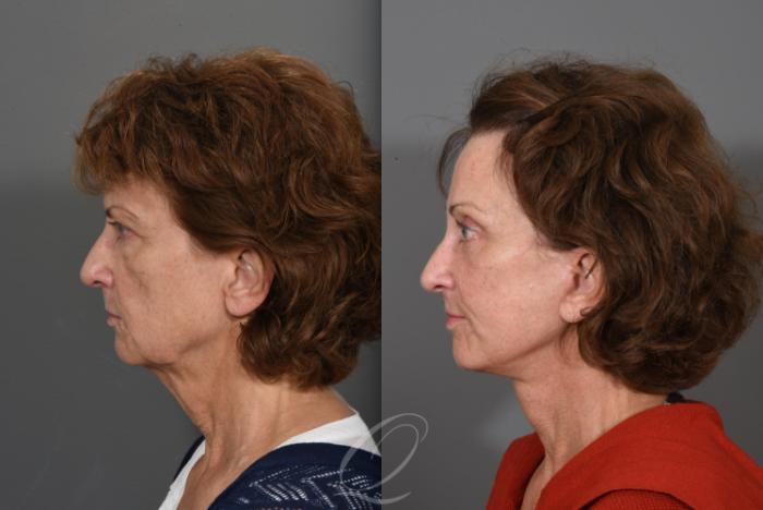 Fat Injections Case 1001547 Before & After Left Side | Serving Rochester, Syracuse & Buffalo, NY | Quatela Center for Plastic Surgery