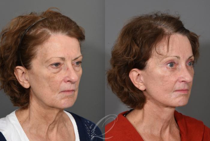 Facelift Case 1001547 Before & After Right Oblique | Serving Rochester, Syracuse & Buffalo, NY | Quatela Center for Plastic Surgery