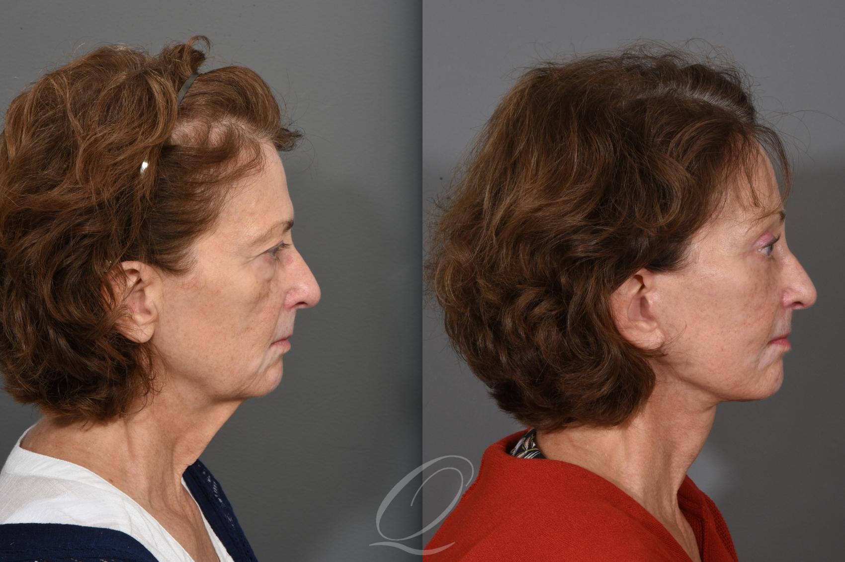 Facelift Case 1001547 Before & After Right Side | Serving Rochester, Syracuse & Buffalo, NY | Quatela Center for Plastic Surgery