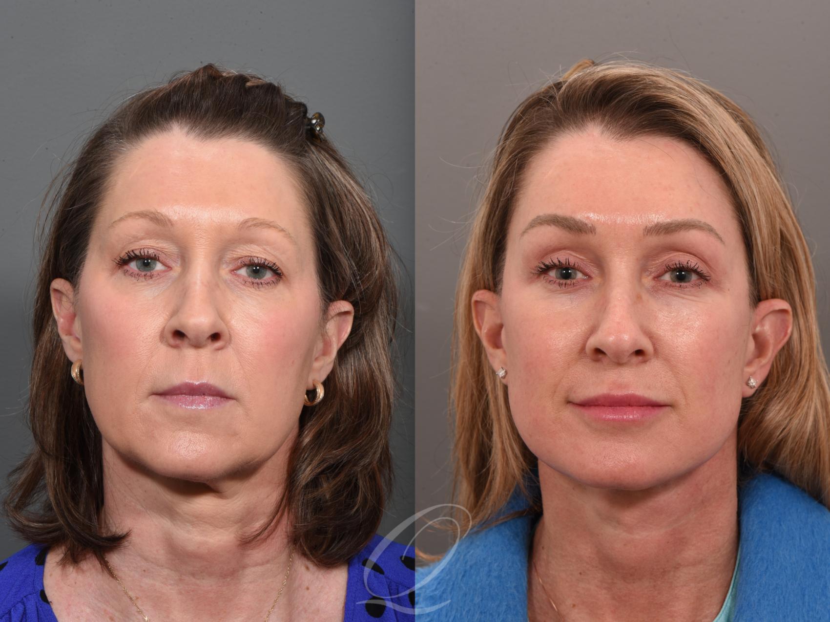 Facelift Before After Photos Patient 1001560 Serving Rochester   Facelift 1001560 Front Detail 