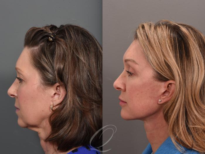 Facelift Case 1001560 Before & After Left Side | Serving Rochester, Syracuse & Buffalo, NY | Quatela Center for Plastic Surgery