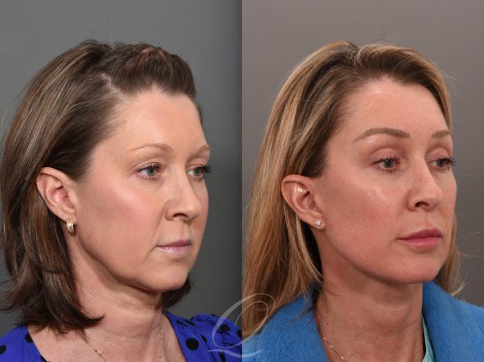 Facelift Case 1001560 Before & After Right Oblique | Serving Rochester, Syracuse & Buffalo, NY | Quatela Center for Plastic Surgery