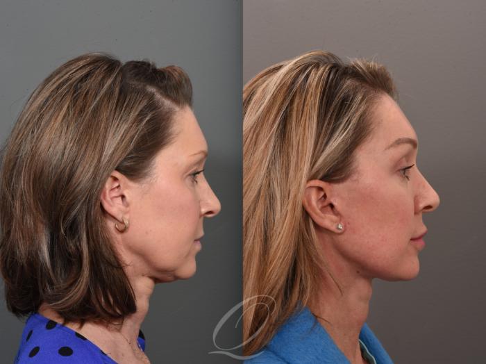 Facelift Case 1001560 Before & After Right Side | Serving Rochester, Syracuse & Buffalo, NY | Quatela Center for Plastic Surgery