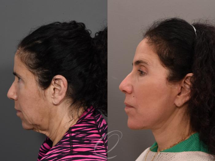 Facelift Case 1001561 Before & After Left Side | Serving Rochester, Syracuse & Buffalo, NY | Quatela Center for Plastic Surgery