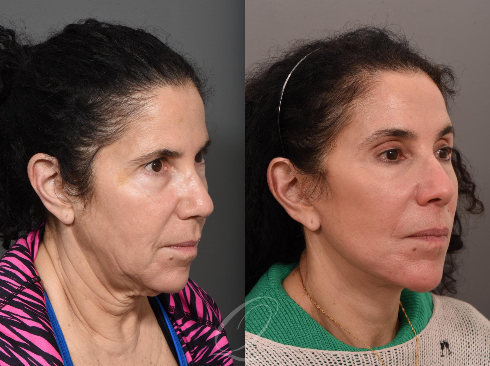 Facelift Case 1001561 Before & After Right Oblique | Serving Rochester, Syracuse & Buffalo, NY | Quatela Center for Plastic Surgery
