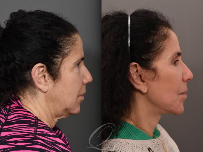 Facelift Case 1001561 Before & After Right Side | Serving Rochester, Syracuse & Buffalo, NY | Quatela Center for Plastic Surgery