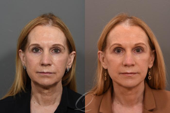 Facelift Case 1001563 Before & After Front | Serving Rochester, Syracuse & Buffalo, NY | Quatela Center for Plastic Surgery