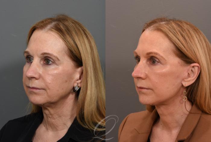 Facelift Case 1001563 Before & After Left Oblique | Serving Rochester, Syracuse & Buffalo, NY | Quatela Center for Plastic Surgery