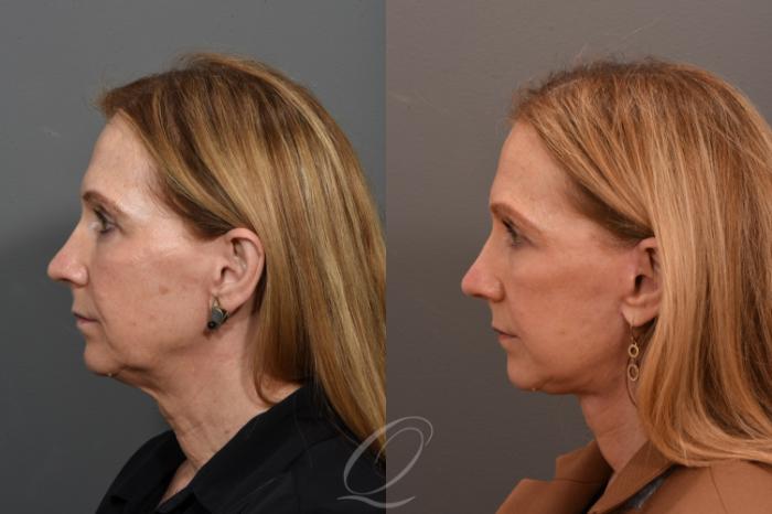 Facelift Case 1001563 Before & After Left Side | Serving Rochester, Syracuse & Buffalo, NY | Quatela Center for Plastic Surgery