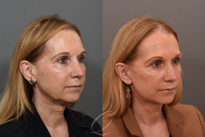 Facelift Case 1001563 Before & After Right Oblique | Serving Rochester, Syracuse & Buffalo, NY | Quatela Center for Plastic Surgery