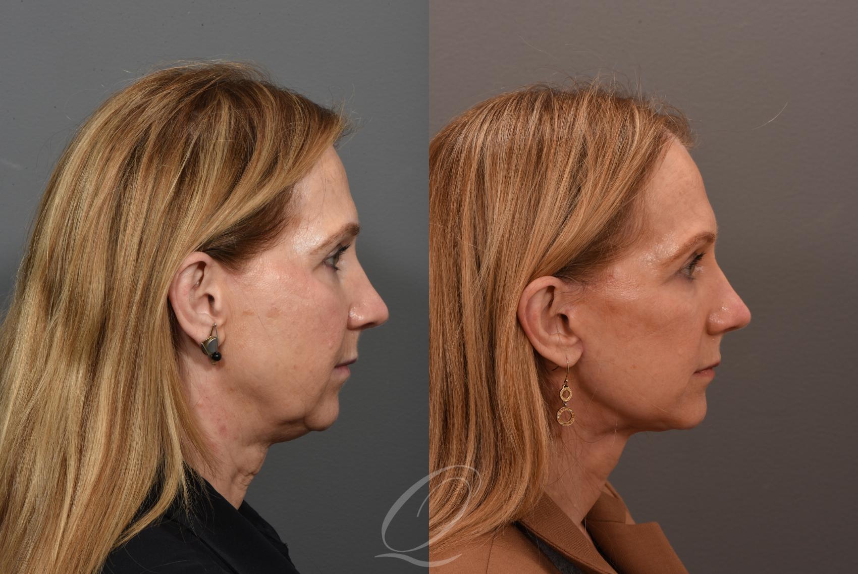 Facelift Case 1001563 Before & After Right Side | Serving Rochester, Syracuse & Buffalo, NY | Quatela Center for Plastic Surgery