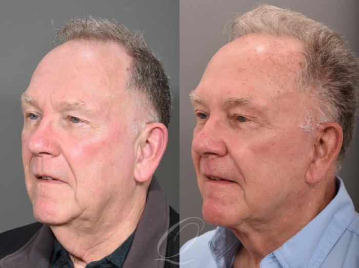 Facelift Case 1001615 Before & After Left Oblique | Serving Rochester, Syracuse & Buffalo, NY | Quatela Center for Plastic Surgery