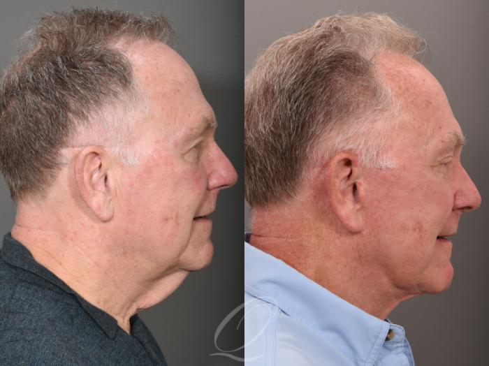 Facelift Case 1001615 Before & After Right Side | Serving Rochester, Syracuse & Buffalo, NY | Quatela Center for Plastic Surgery