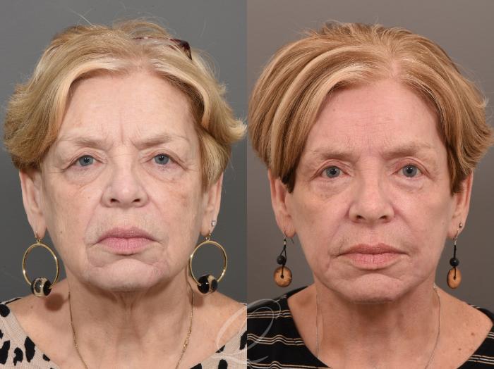 Facelift Case 1001625 Before & After Front | Serving Rochester, Syracuse & Buffalo, NY | Quatela Center for Plastic Surgery