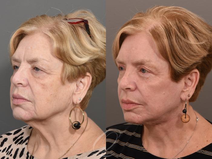 Facelift Case 1001625 Before & After Left Oblique | Serving Rochester, Syracuse & Buffalo, NY | Quatela Center for Plastic Surgery