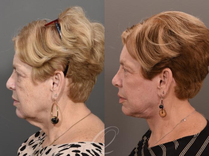 Facelift Case 1001625 Before & After Left Side | Serving Rochester, Syracuse & Buffalo, NY | Quatela Center for Plastic Surgery