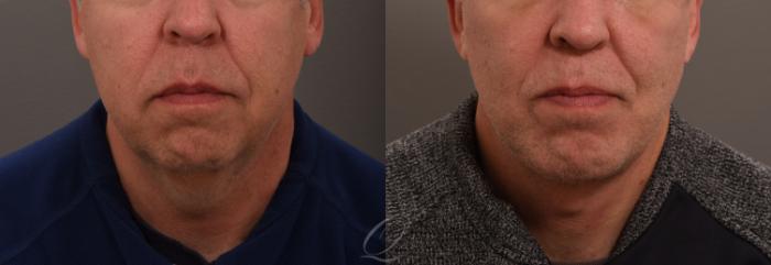 Chin Augmentation Case 1001635 Before & After Front | Serving Rochester, Syracuse & Buffalo, NY | Quatela Center for Plastic Surgery